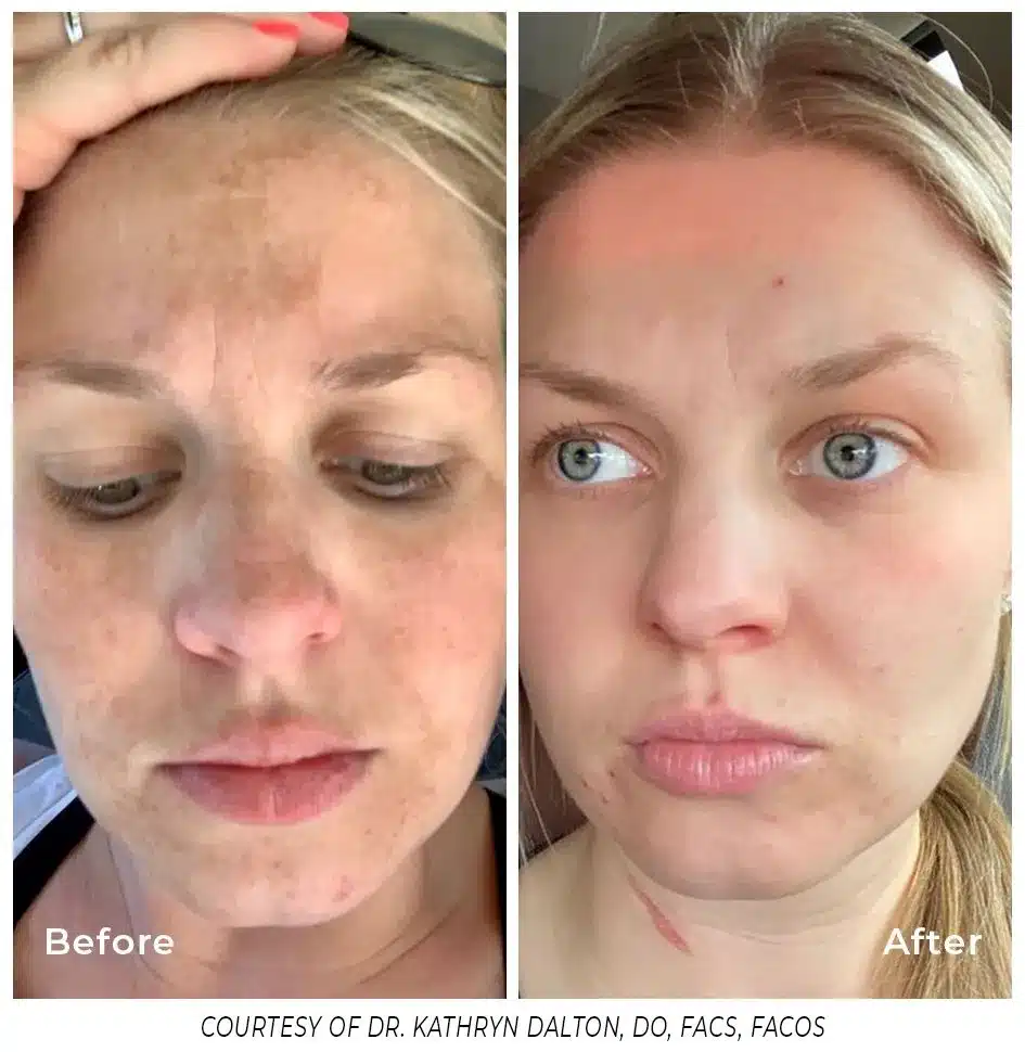 A woman with acne and before and after