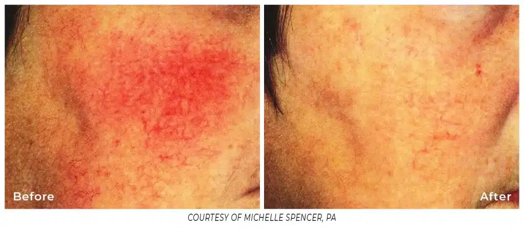 A before and after photo of the redness on the face.
