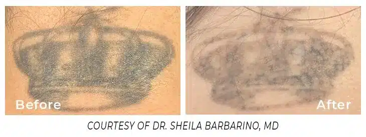 A before and after picture of the hair removal process.