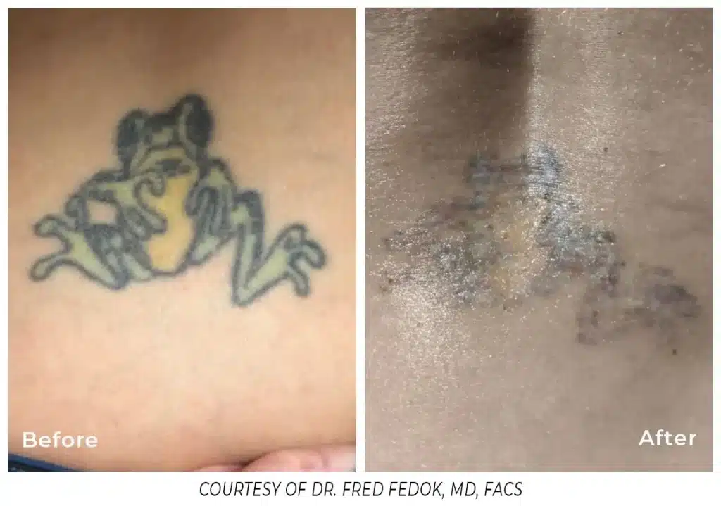A before and after picture of the tattoo removal process.