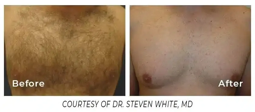 A before and after picture of the chest area.